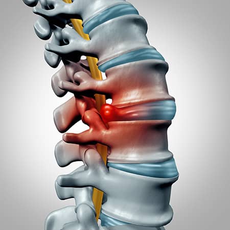 Illustration of a herniated disc. Spinal decompression restores nutrient-rich fluids to the disc and relieves pressure on spinal nerves.